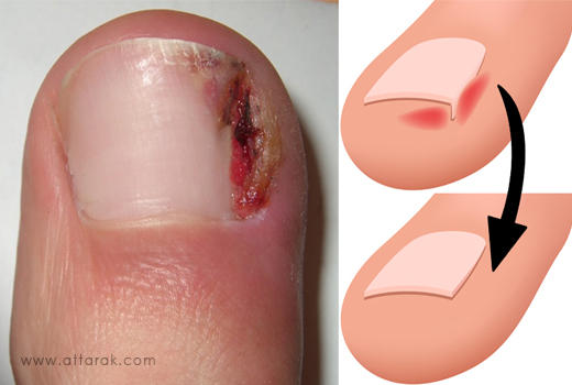 درمان فرو رفتن ناخن در گوشت انگشت پا