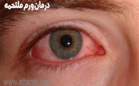 روش هایی برای تسکین و درمان ورم ملتحمه چشم