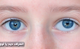 انحراف چشم یا لوچی چیست
