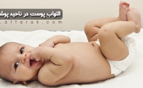 علل التهاب پوست در ناحیه پوشک نوزاد