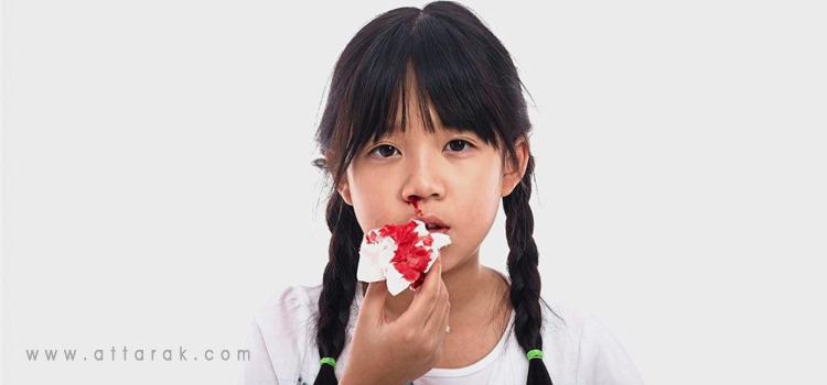 علت خونریزی بینی در کودکان چیست ؟