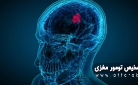 عاقبت بیماران مبتلا به تومور مغزی