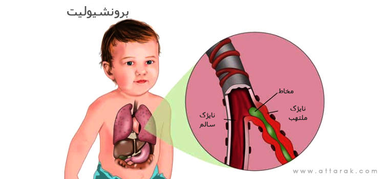 درمان بیماری برونشیولیت در کودکان