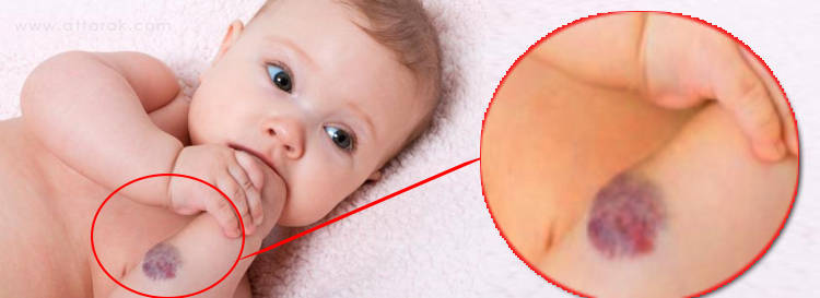 ناهنجاری های پوست و مو در کودکان