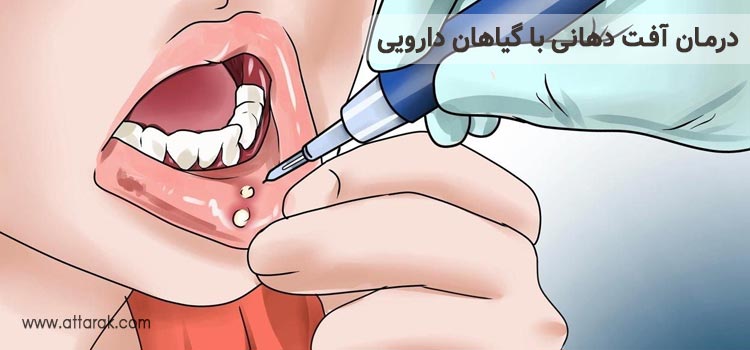 درمان آفت دهانی با گیاهان دارویی
