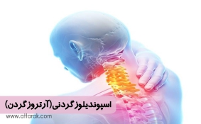 اسپوندیلوز گردنی (آرتروز گردن)