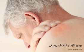بیماری اگزما پوستی چیست