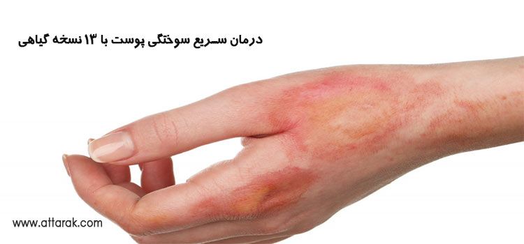 درمان سوختگی پوست با 13 نسخه گیاهی و شفابخش در طب سنتی