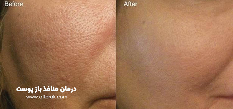 منافذ باز پوست شما در 3 روز برای همیشه از بین خواهد رفت