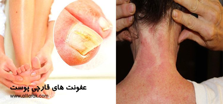 عفونت های قارچی پوست (علل، علائم و درمان آن)