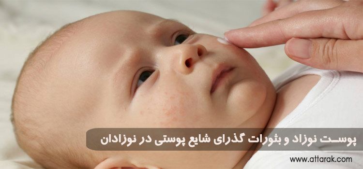 پوست نوزاد و بثورات گذرای شایع پوستی در نوزادان