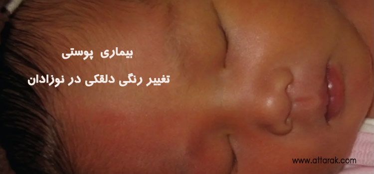 پوست نوزاد و بثورات گذرای شایع پوستی در نوزادان