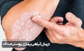 8 راهکار خانگی و درمان گیاهی بیماری پوستی صدف (پسوریازیس)