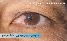 7 درمان طبیعی بیماری ناخنک چشم