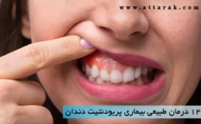 14 درمان طبیعی بیماری پریودنتیت دندان