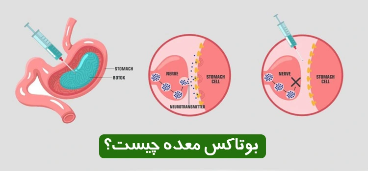 بوتاکس معده چیست؟