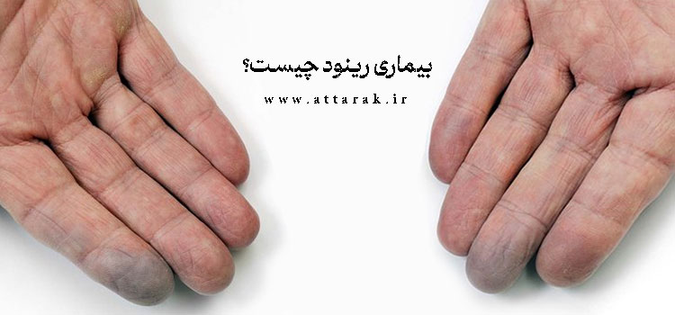 بیماری رینود چیست؟