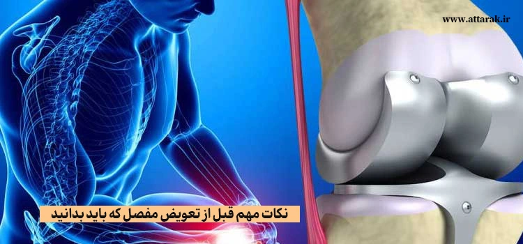 نکات مهم قبل از تعویض مفصل که باید بدانید