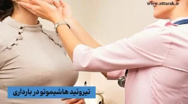 تیروئید هاشیموتو در بارداری