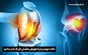 نکات مهم قبل از تعویض مفصل