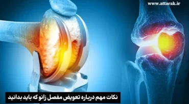 نکات مهم قبل از تعویض مفصل