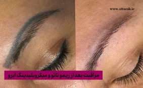 مراقبت بعد از ریمو تاتو و میکروبلیدینگ ابرو