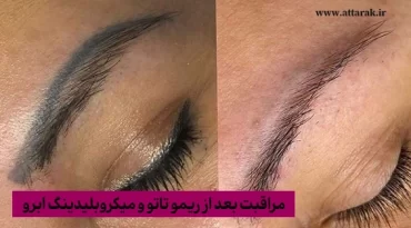 مراقبت بعد از ریمو تاتو و میکروبلیدینگ ابرو