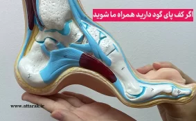 اگر کف پای گود دارید همراه ما شوید