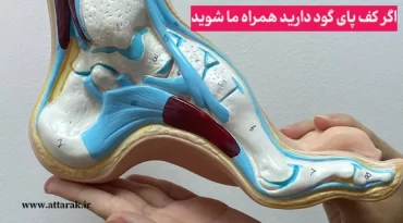 اگر کف پای گود دارید همراه ما شوید