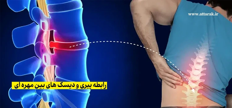 رابطه پیری و دیسک های بین مهره ای