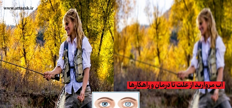 آب مروارید از علت تا درمان و راهکارها