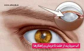 آب مروارید از علت تا درمان و راهکارها