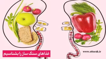 غذاهای سنگ ساز را بشناسیم