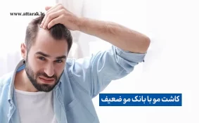 کاشت مو برای افراد با بانک موی ضعیف