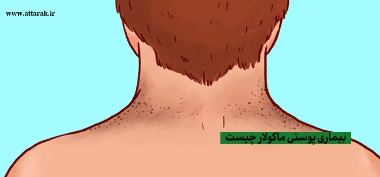 بیماری پوستی ماکولار