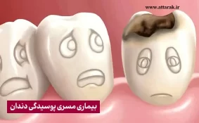 پوسیدگی دندان یک بیماری مسری