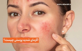 اگزمای پوستی شدید چیست؟