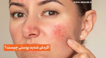 اگزمای پوستی شدید چیست؟